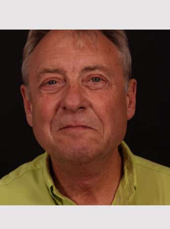 After Image: Neck Lift - front
