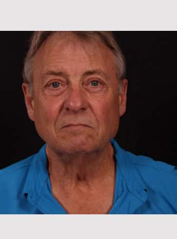 Before Image: Neck Lift - front