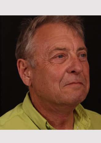 After Image: Neck Lift - right-front-oblique