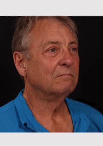 Before Image: Neck Lift - right-front-oblique