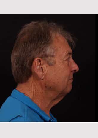Before Image: Neck Lift - right-side