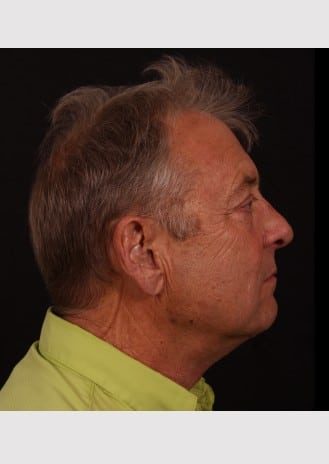 After Image: Neck Lift - right-side