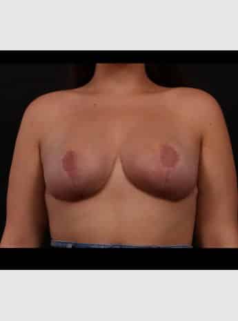 After Image: Mastopexy (Breast Lift) - front