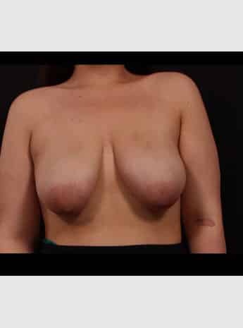 Before Image: Mastopexy (Breast Lift) - front