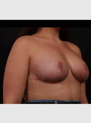 After Image: Mastopexy (Breast Lift) - right-front-oblique
