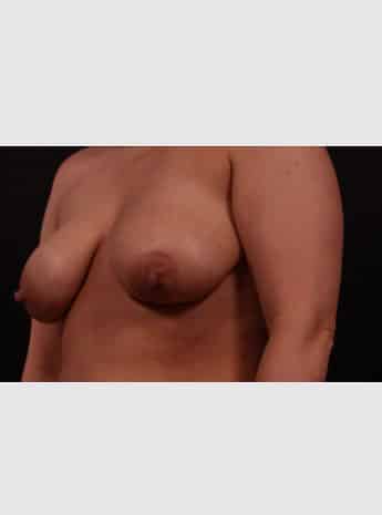 Before Image: Mastopexy (Breast Lift) - left-front-oblique