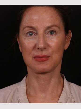 After Image: Neck Lift / Lower Facelift - front