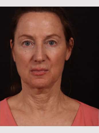 Before Image: Neck Lift / Lower Facelift - front