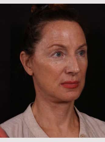 After Image: Neck Lift / Lower Facelift - right-front-oblique