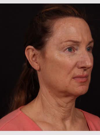 Before Image: Neck Lift / Lower Facelift - right-front-oblique
