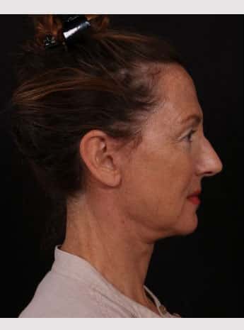 After Image: Neck Lift / Lower Facelift - right-side