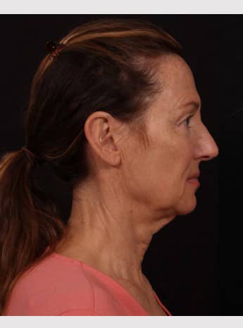 Before Image: Neck Lift / Lower Facelift - right-side