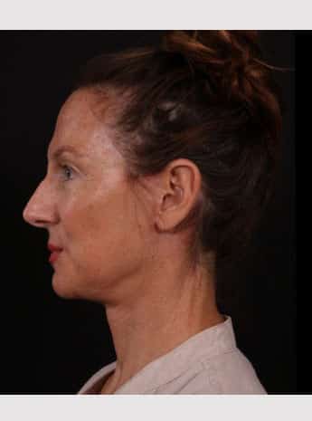 After Image: Neck Lift / Lower Facelift - left-side