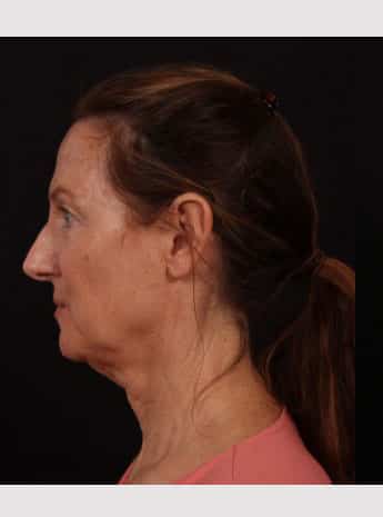 Before Image: Neck Lift / Lower Facelift - left-side