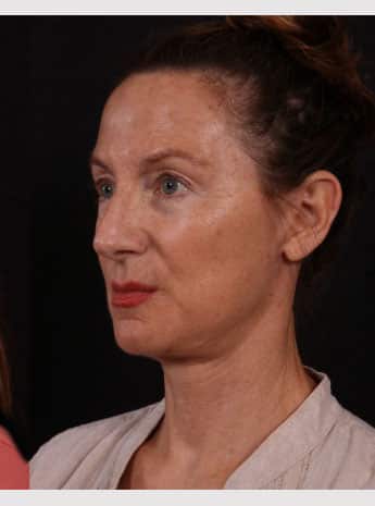 After Image: Neck Lift / Lower Facelift - left-front-oblique