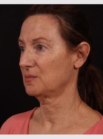 Before Image: Neck Lift / Lower Facelift - left-front-oblique