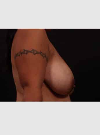 Before Image: Mastopexy (Breast Lift) - right-side
