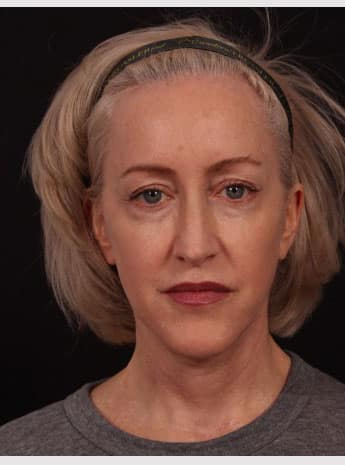 After Image: Neck Lift / Lower Facelift - front