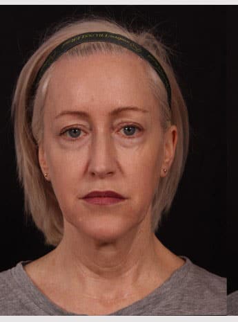 Before Image: Neck Lift / Lower Facelift - front
