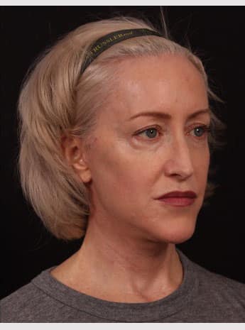 After Image: Neck Lift / Lower Facelift - right-front-oblique