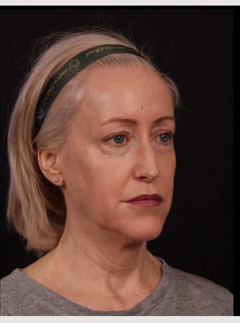 Before Image: Neck Lift / Lower Facelift - right-front-oblique