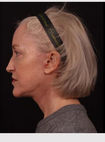 After Image: Neck Lift / Lower Facelift - left-side