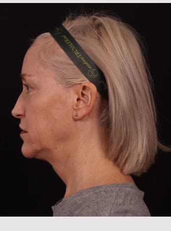 Before Image: Neck Lift / Lower Facelift - left-side