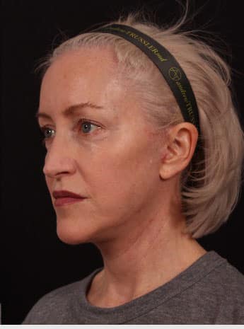 After Image: Neck Lift / Lower Facelift - left-front-oblique