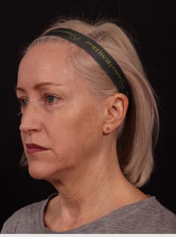 Before Image: Neck Lift / Lower Facelift - left-front-oblique