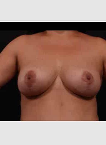 After Image: Mastopexy (Breast Lift) - front