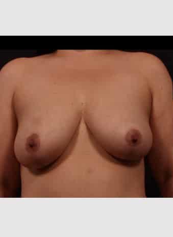 Before Image: Mastopexy (Breast Lift) - front