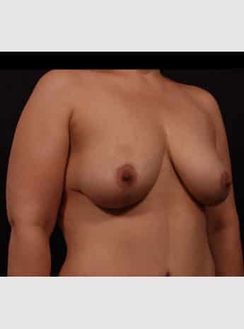 Before Image: Mastopexy (Breast Lift) - right-front-oblique