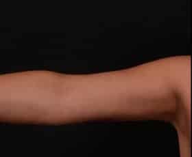 After Image: Brachioplasty (Arm Lift) - front