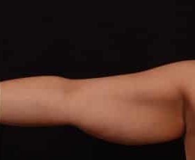 Before Image: Brachioplasty (Arm Lift) - front