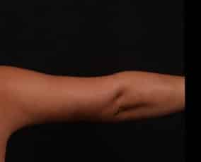 After Image: Brachioplasty (Arm Lift) - back