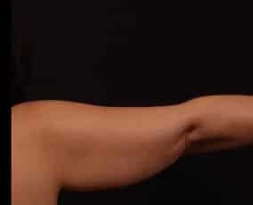 Before Image: Brachioplasty (Arm Lift) - back