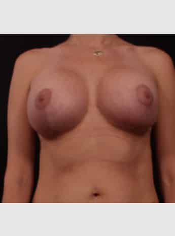 Breast Lift ( Mastopexy) with Augmentation