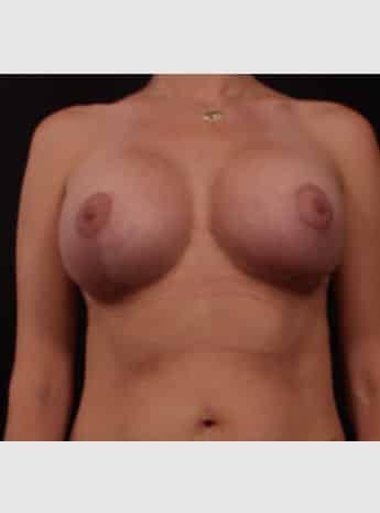 After Image: Breast Lift ( Mastopexy) with Augmentation - front