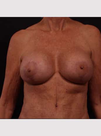 After Image: Breast Lift (Mastopexy) with Augmentation - front