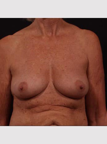 Before Image: Breast Lift (Mastopexy) with Augmentation - front