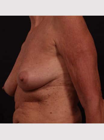 Before Image: Breast Lift (Mastopexy) with Augmentation - left-front-oblique