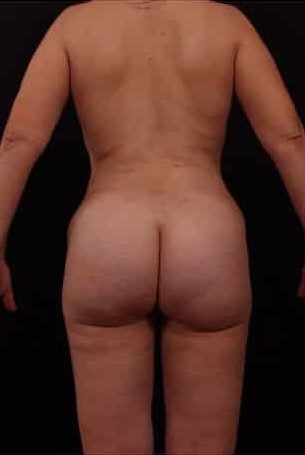 After Image: Mommy Makeover - back