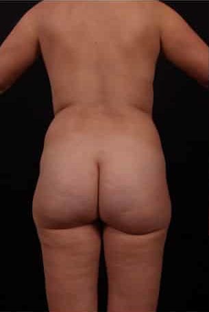 Before Image: Mommy Makeover - back