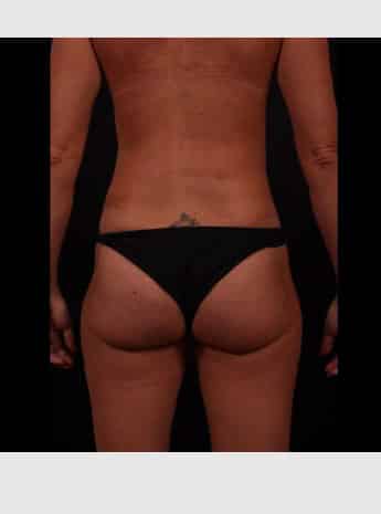 After Image: Liposuction - back