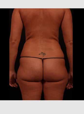 Before Image: Liposuction - back