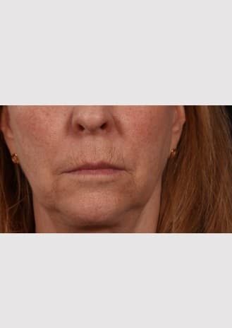Before Image: Lip Lift - front