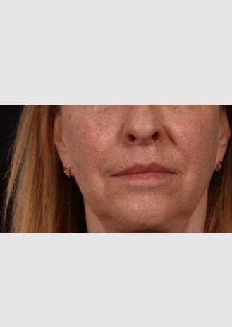 After Image: Lip Lift - front