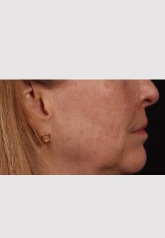 After Image: Lip Lift - right-side
