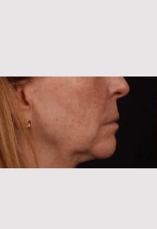 Before Image: Lip Lift - right-side