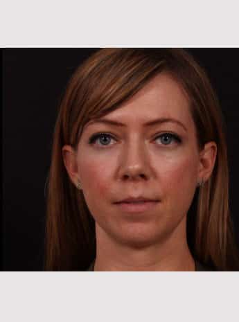 After Image: Lip Lift - front